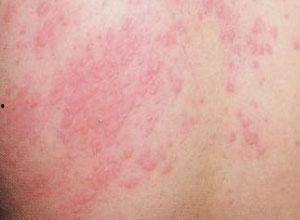 湿疹吃角瓜好吗,角瓜的养生功效解析